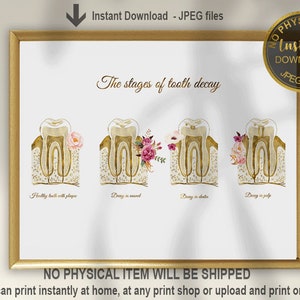 The Stages of Tooth Decay Print, Dentist Poster, Dental Hygienist Office, Dental Assistant Gift, Dental Clinic Decor, Dental Printable Art