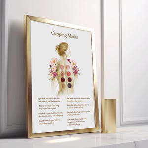 Cupping Therapy Art Print for Holistic Healing Rooms | Traditional Cupping Poster for Massage & Wellness Spaces | Printable Wall Art image 3