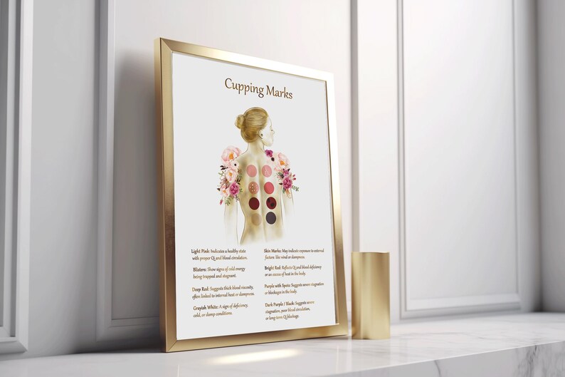 Cupping Therapy Art Print for Holistic Healing Rooms | Traditional Cupping Poster for Massage & Wellness Spaces | Printable Wall Art image 3