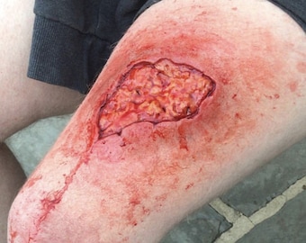 Große Ausgesetzte Fettgewebe Prothetische Wunde