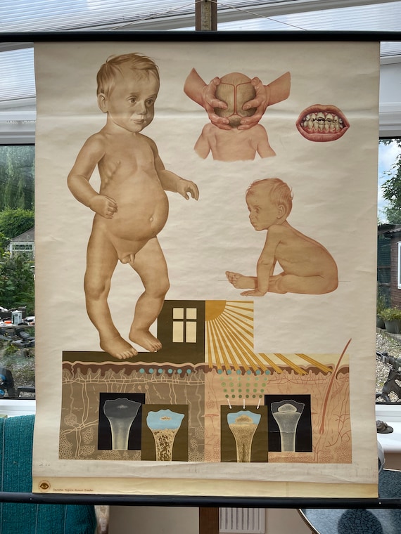 Rickets Children