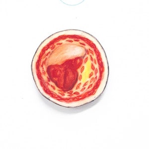 Plaque Formation And Thrombus Arterial Blood Clot Pin Badge -- Unique Handmade Item -- Science Gifts