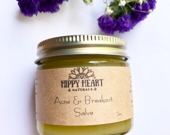 Acne prone Moisturizer, breakout Salve, acne treatment, rosacea, vegan, dark marks, fade acne scars, oily skin, light moisturizer