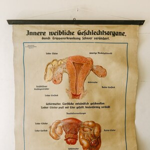 Original ANATOMICAL Vintage German School Wall Chart GONORRHEA In Women Anatomy Medicine Venereal Disease Illness Science Graphic Rare