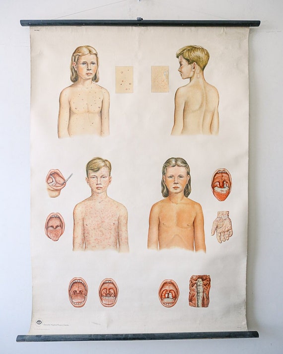 Original ANATOMICAL Vintage German School Wall Chart CHILDHOOD DISEASES Measles Chicken Pox Anatomy Medicine Science Beautiful Rare