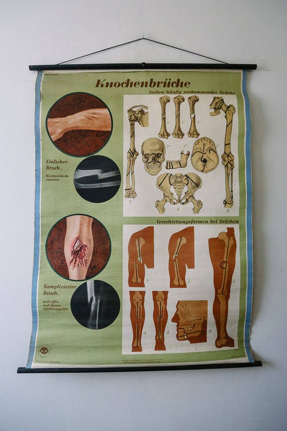 Original ANATOMICAL Vintage German Educational School Wall Chart BONE FRACTURES Breaks Medicine Deutsches Science Museum Beautiful Rare