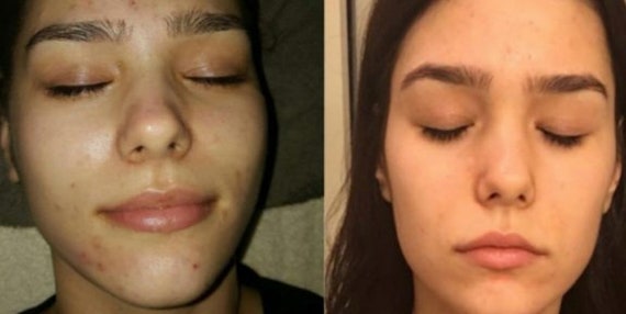Green Herbal Deep Sea Skin Peel Chemical Acid Free Acne Etsy