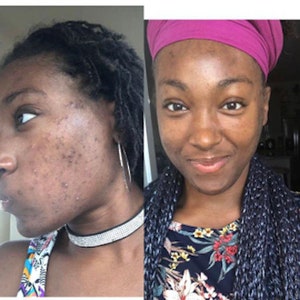 May include: A split image showing a person's face before and after skincare. The left side shows acne and blemishes. The right side shows clear skin, a pink head covering, and a floral top.
