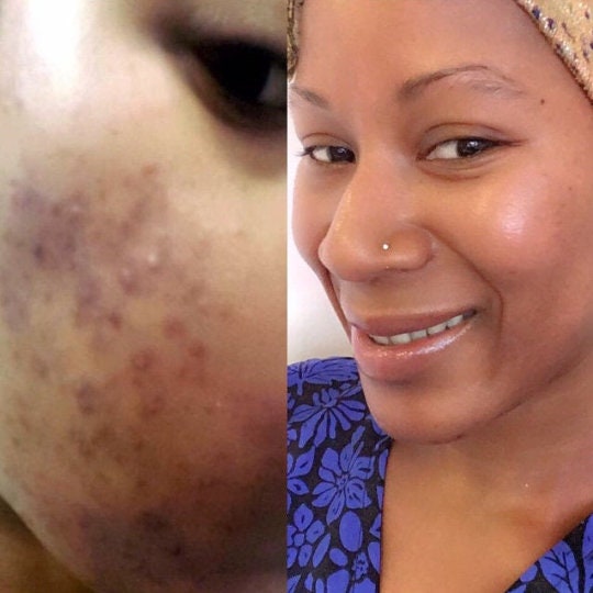 Sensitive Acne Prone Skin Face Cream great for Beards 2oz. Etsy