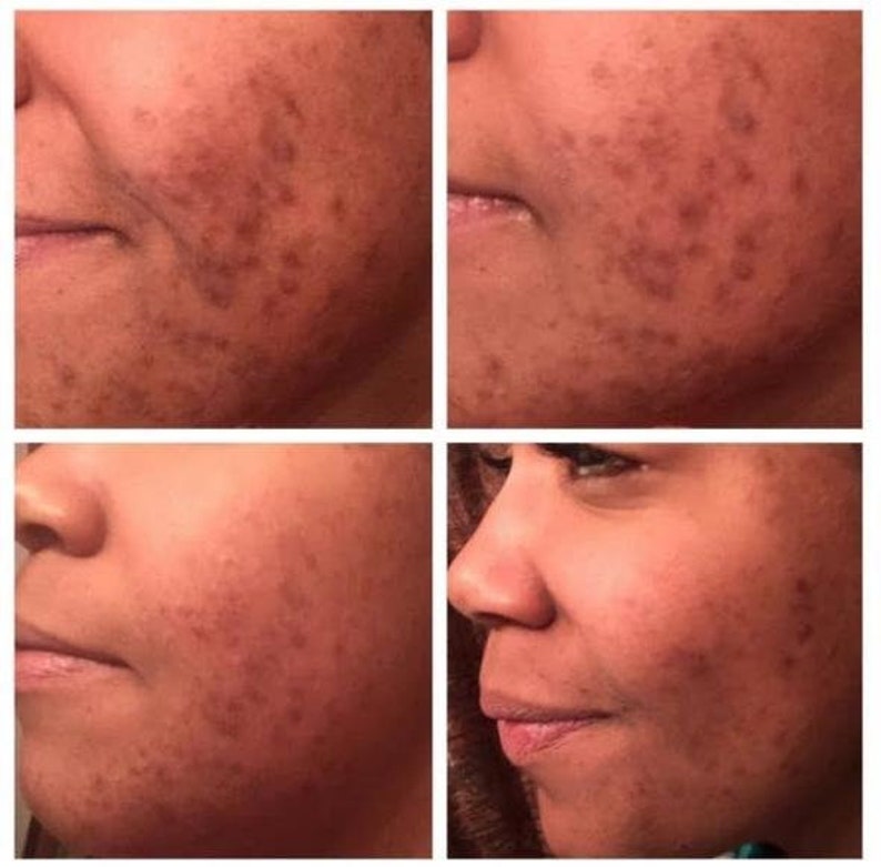 Rose Face Oil for Acne hyperpigmentation dark spots dull Etsy