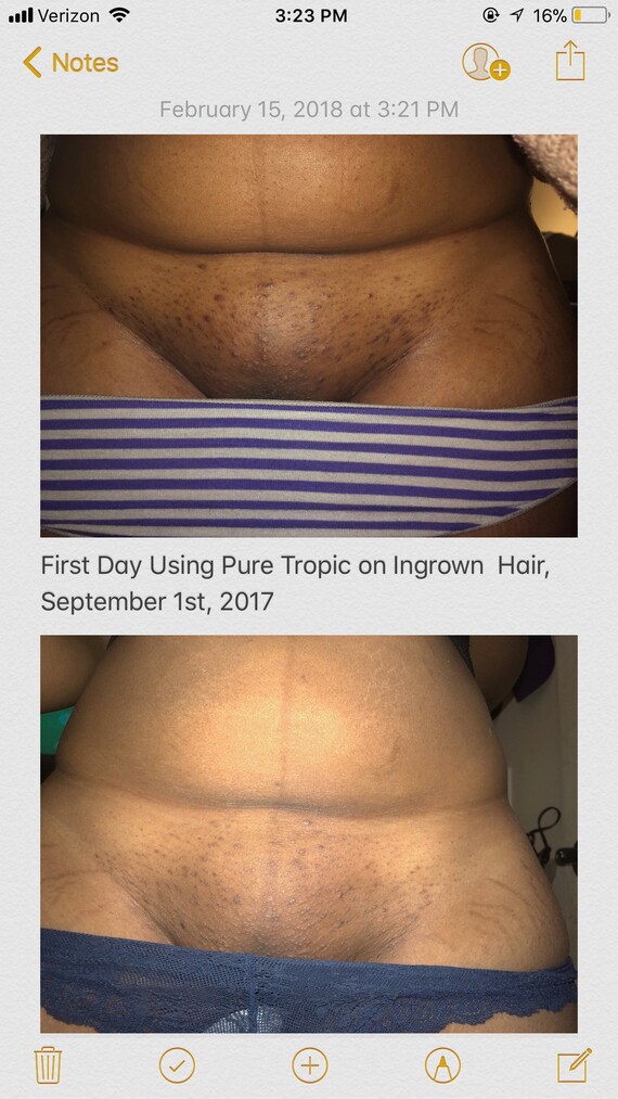 Ingrown Hair Serum Shave Bump Prevention All Natural Skin Etsy