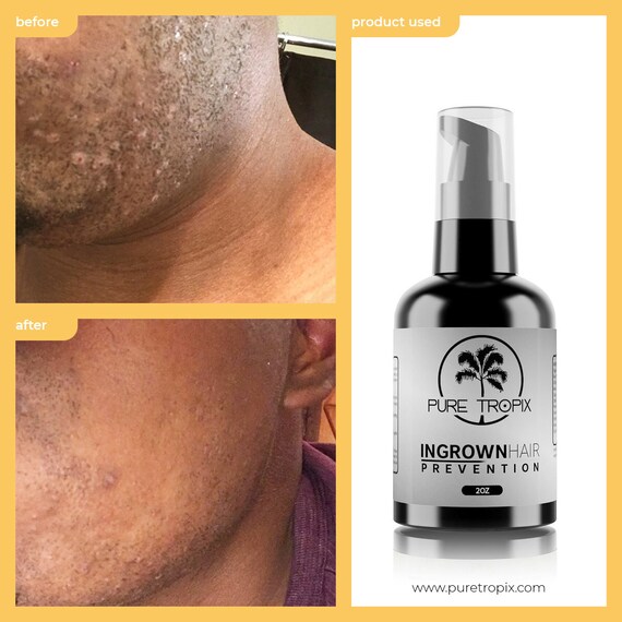 Ingrown Hair Serum Shave Bump Prevention All Natural Skin Etsy