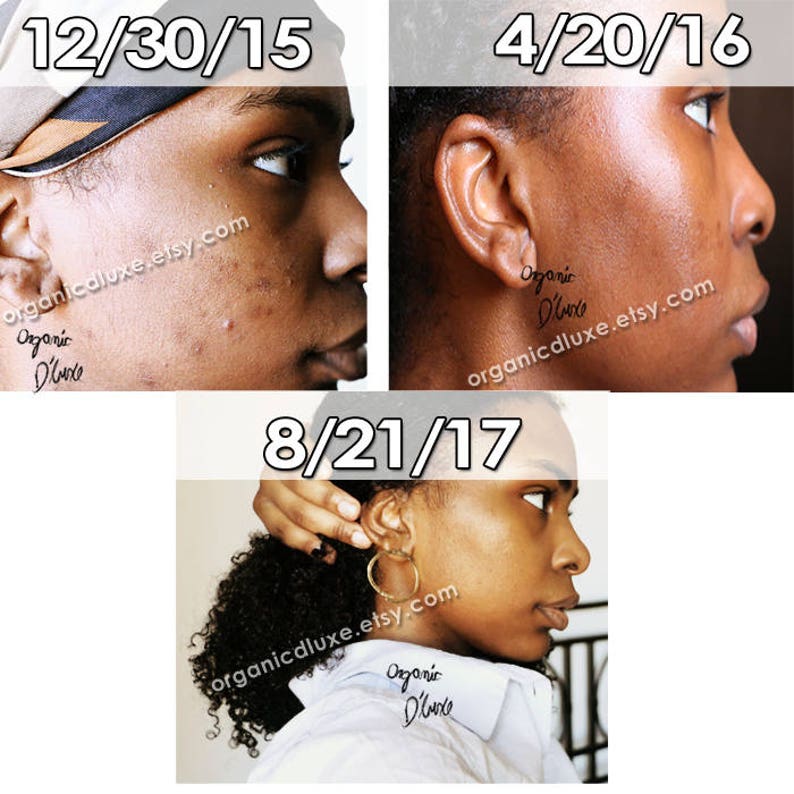 Hyperpigmented and Acne Prone Skin Facial Serum Oil Cleanser Etsy