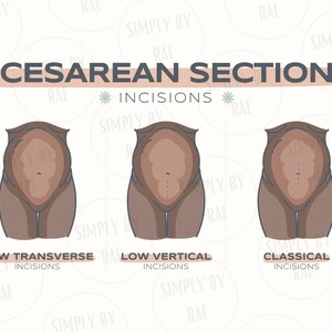 May include: An illustration depicting three types of Cesarean section incisions: low transverse, low vertical, and classical. Each shows a stylized representation of a torso with the incision marked in red. The text "Cesarean Section Incisions" is at the top.