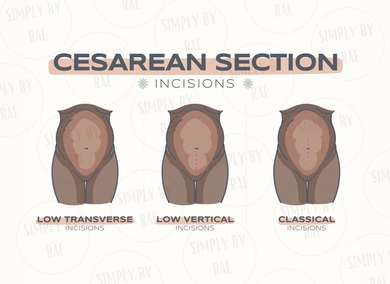 May include: An illustration depicting three types of Cesarean section incisions: low transverse, low vertical, and classical. Each shows a stylized representation of a torso with the incision marked in red. The text "Cesarean Section Incisions" is at the top.