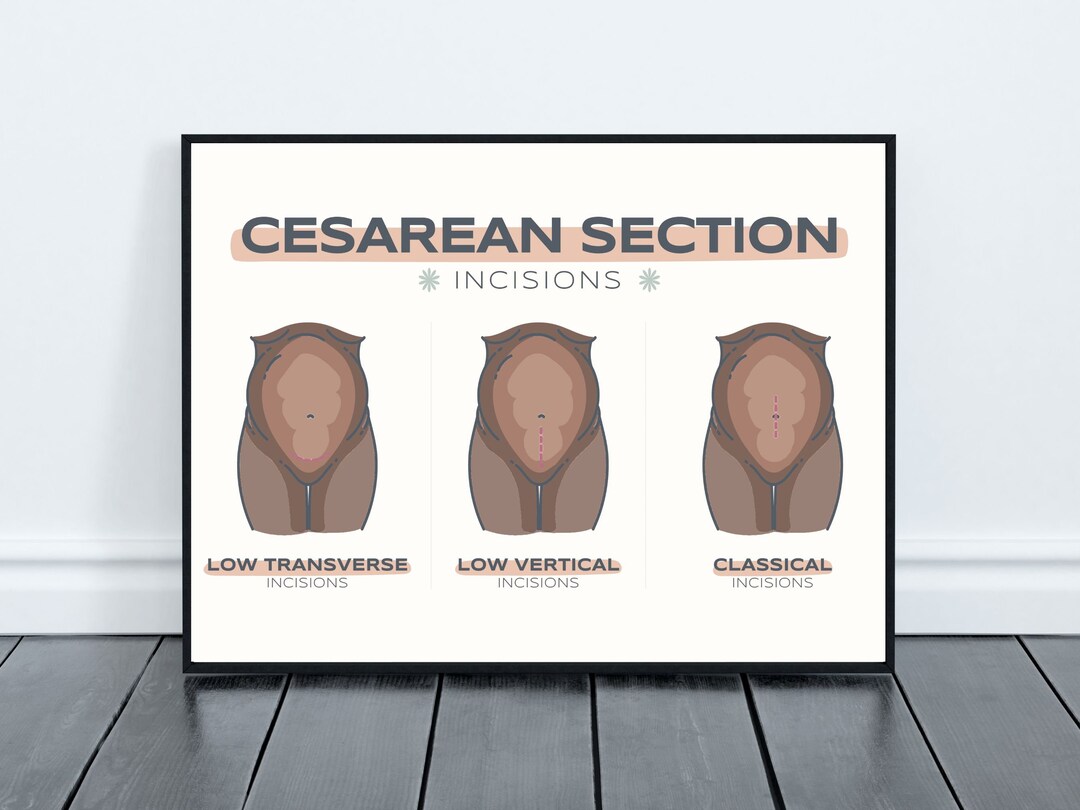 Black Woman Prenatal Anatomy Art Fetus Infographic Bundle, C-section ...