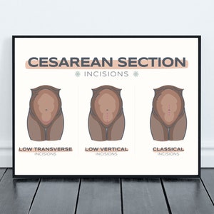 May include: A framed print with the words "Cesarean Section" and illustrations of three types of incisions: low transverse, low vertical, and classical. The illustrations depict the abdomen with incision lines.