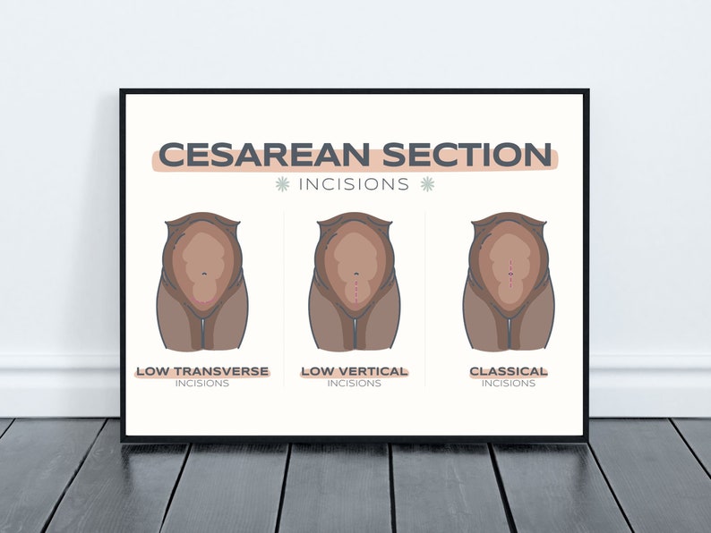 May include: A framed print with the words "Cesarean Section" and illustrations of three types of incisions: low transverse, low vertical, and classical. The illustrations depict the abdomen with incision lines.