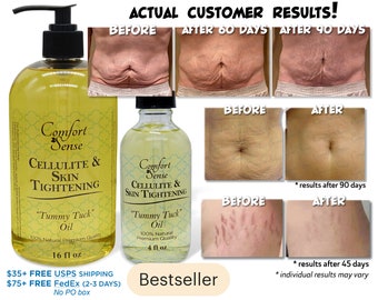 Stretch Marks Etsy