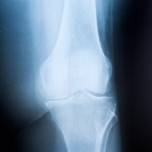 May include: X-ray image of a human knee joint. The bones are clearly visible, showing the structure of the knee.