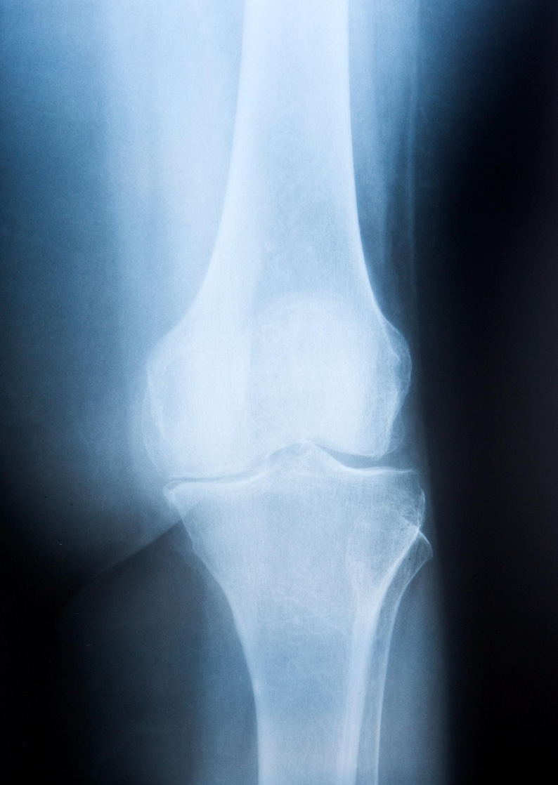 May include: X-ray image of a human knee joint. The bones are clearly visible, showing the structure of the knee.