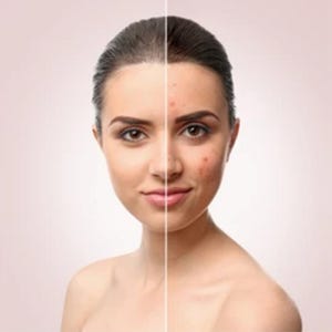 以下が含まれることがあります： 女性の顔を半分に割ったポートレートで、片側はきれいな肌、もう片側は肌の欠陥を示しています。女性は黒髪で、視聴者を見ています。