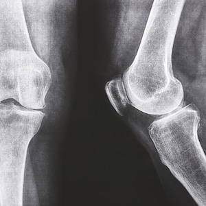 May include: X-ray image of two human knees, showing the bones and joints.