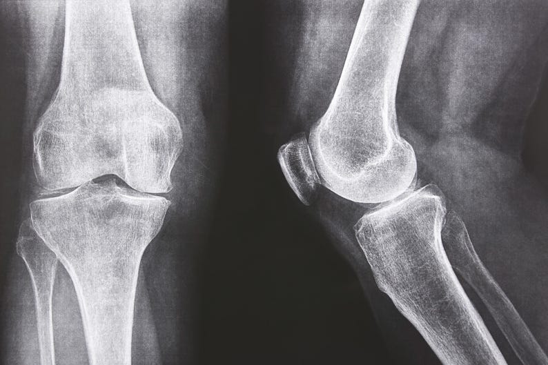 May include: X-ray image of two human knees, showing the bones and joints.