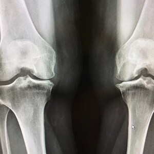 May include: X-ray image of two human knees, showing the bones and joints.
