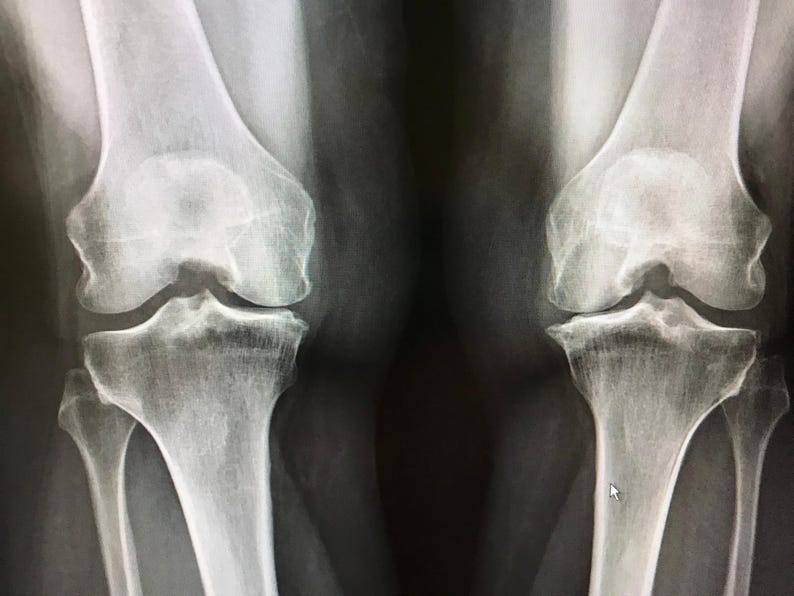 May include: X-ray image of two human knees, showing the bones and joints.