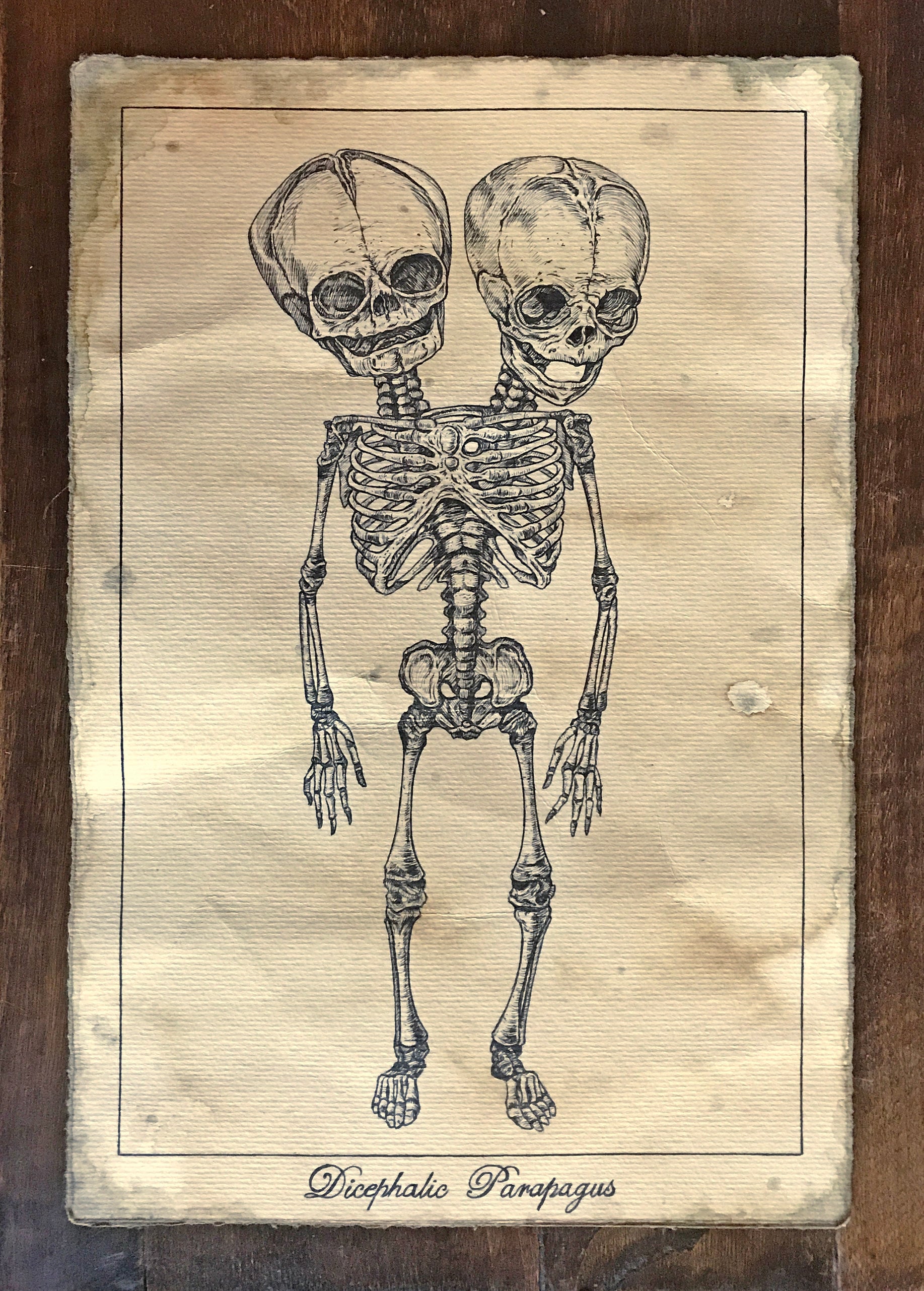 Conjoined Twins Skeleton Original Drawing Medical Illustration Worn Paper  Horror Art - Etsy