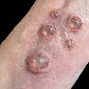 Prosthetic jewel wound. Silicone prosthetic appliance.