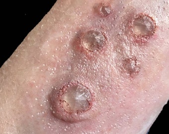 Prosthetic jewel wound. Silicone prosthetic appliance.