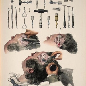 Antieke Ars Medica Medische Chirurgische Illustratie Voorbeelden van Trephining Tools A3 Herdruk