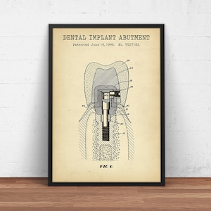 Dental Implant Abutment Patent Print,  Blueprint Art, Dental Hygienist Gift, Orthodontist Wall Art, Dental Office Decor