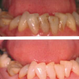 Hydroxyapatite powder for strengthening and remineralising teeth image 6