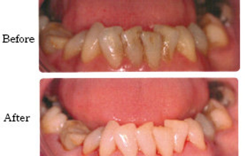 Hydroxyapatite powder for strengthening and remineralising teeth image 6