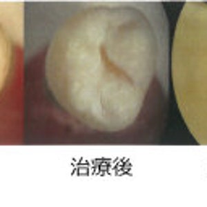 Hydroxyapatite powder for strengthening and remineralising teeth image 3