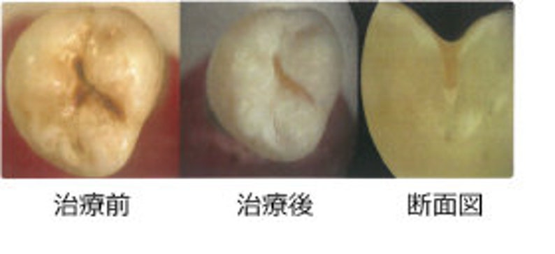 Hydroxyapatite powder for strengthening and remineralising teeth image 3