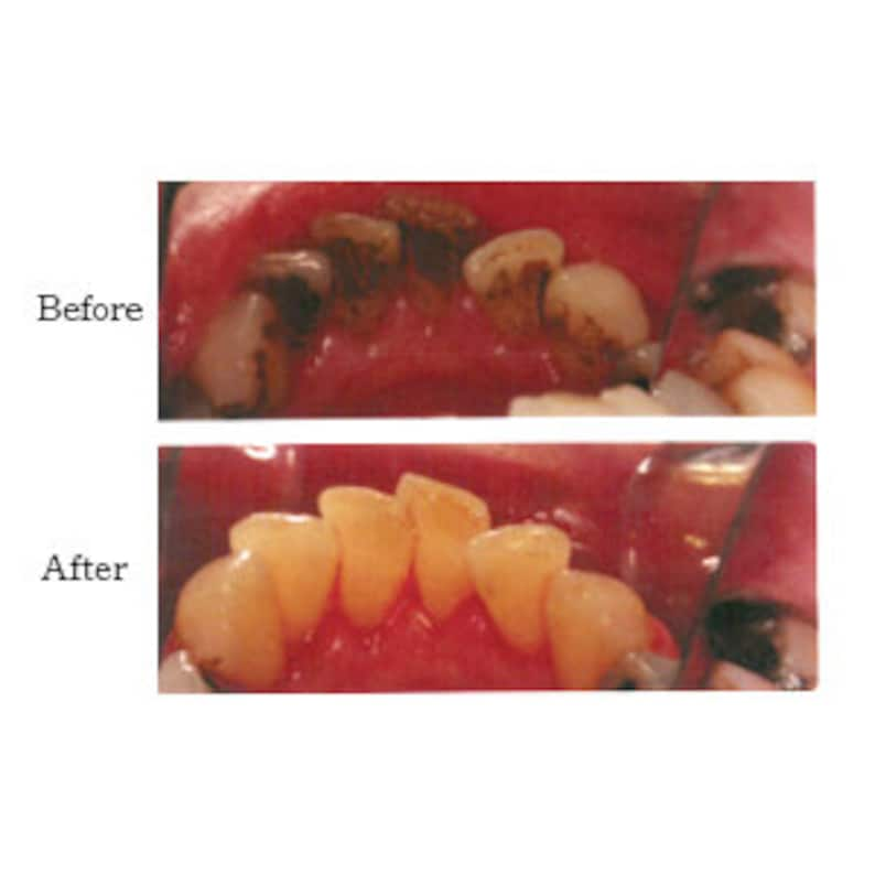 Hydroxyapatite powder for strengthening and remineralising teeth image 5