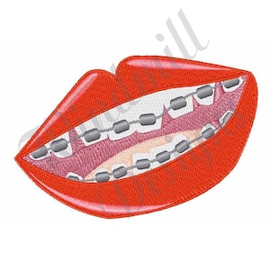 May include: Red lips with a set of silver braces. The teeth are visible behind the braces.