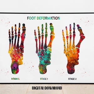 Foot Deformation Stages Orthopedics Art Podiatry Decor biology Poster Medical Science Watercolor Digital Printable Download