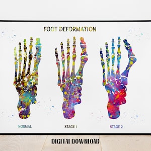 Foot Deformation Stages Orthopedics Art Podiatry Decor biology Poster Medical Science Watercolor Digital Printable Download