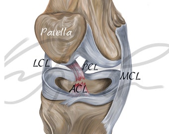 Torn ACL - Printable Download, Digital illustration, Medical drawing, Human anatomy, Knee joint, Knee ligaments, Anterior Cruciate Ligament