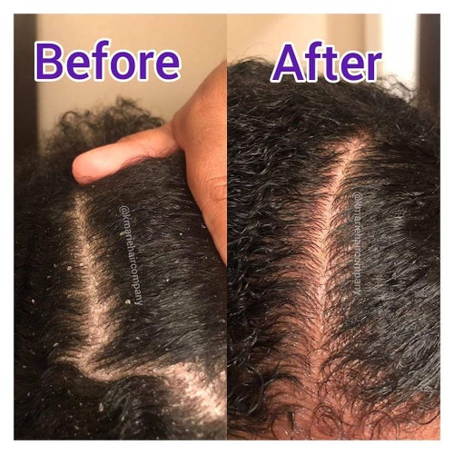 Seborrheic Dermatitis Natural Scalp & Skin Treatment Mask Etsy