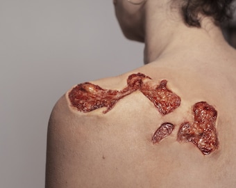 May include: A close-up of a person's back with a large, red, and brown wound on their shoulder.
