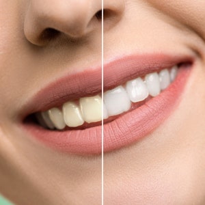 Teeth Whitening Photoshop Action, White Teeth Photoshop Action, Photoshop Action, Retouching Action, Retouch Preset, Photoshop Retouch Tools