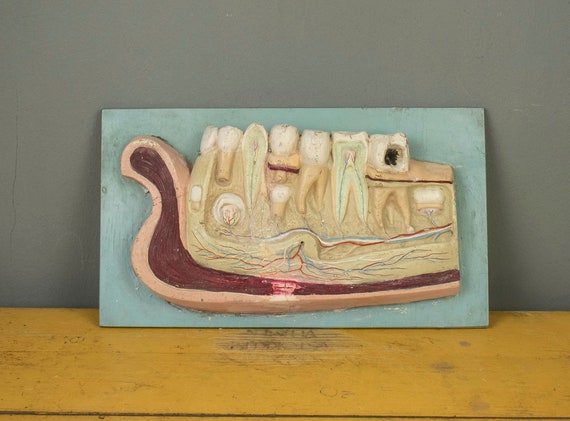 Educational Vintage Plaster Model for Dental Medicine