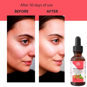 May include: Before and after photos of a person's face showing the results of using Ashwagandha Oil. The oil is in a clear glass bottle with a dropper. The bottle label says "Ashwagandha Oil" and lists the ingredients as "Infusion of Ashwagandha (Withania somnifera roots) in organic Sesame Seed Oil".