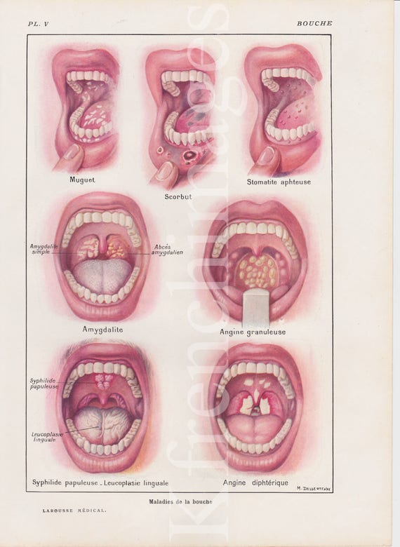 Mouth Diseases Anatomy Plate French Vintage Original Print Etsy